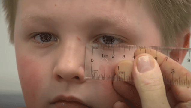 A young boy looks toward the camera as a dr measures his eye with a small ruler